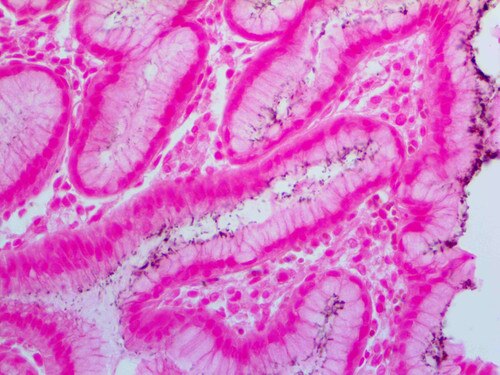 Helicobacter pylori Antibody Immunohistochemistry BSB-37 on a FFPE Infected Stomach Tissue
